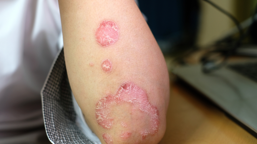 Det huvudsakliga målet med att ta fram nationella riktlinjer för psoriasis är att sprida kunskapen om att sjukdomen är så mycket mer än bara fjällande hud.  Foto: Shutterstock